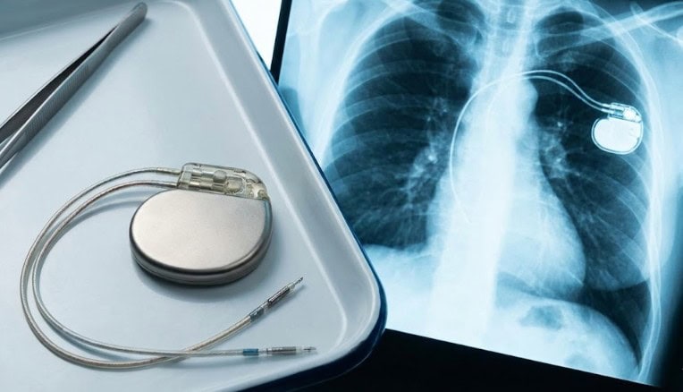 Šta je Ugradnja pejsmejkera